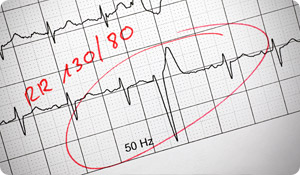 Heart Arrhythmias: Know the Signs, Prevent Complications