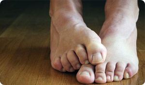 Itchy Issues: Athlete's Foot and Jock Itch