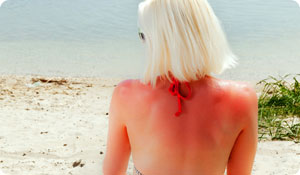 9 Ways to Treat a Sunburn